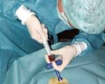 «الإمارات للسكري» تحذر من علاج السكري بالخلايا الجذعية